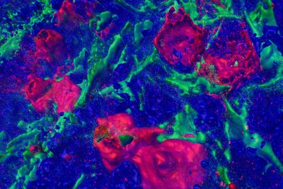 three-dimensional view of several red-labelled CD30-positive lymphocytes in an inflamed lymph node